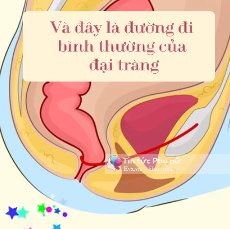 Chỉ vì chiếc bồn cầu con có nguy cơ bị ung thư đại tràng