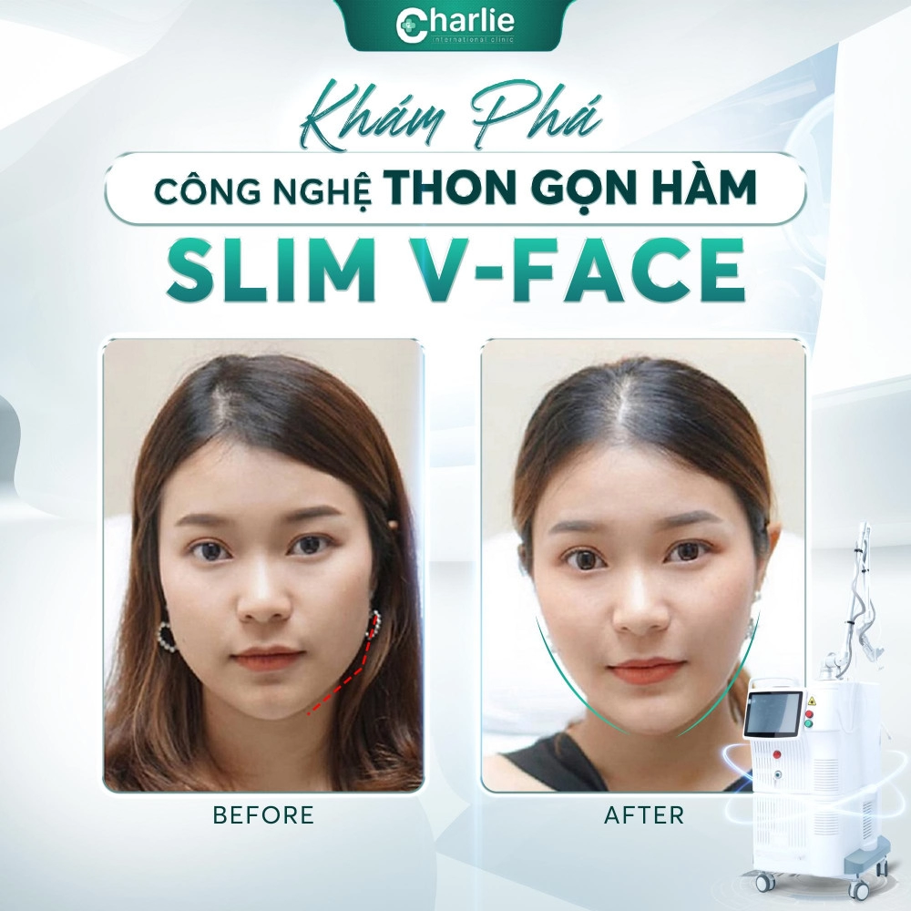 Công nghệ thon gọn hàm không phẫu thuật slim v-face - bước tiến ưu việt trong công nghệ làm đẹp 2024