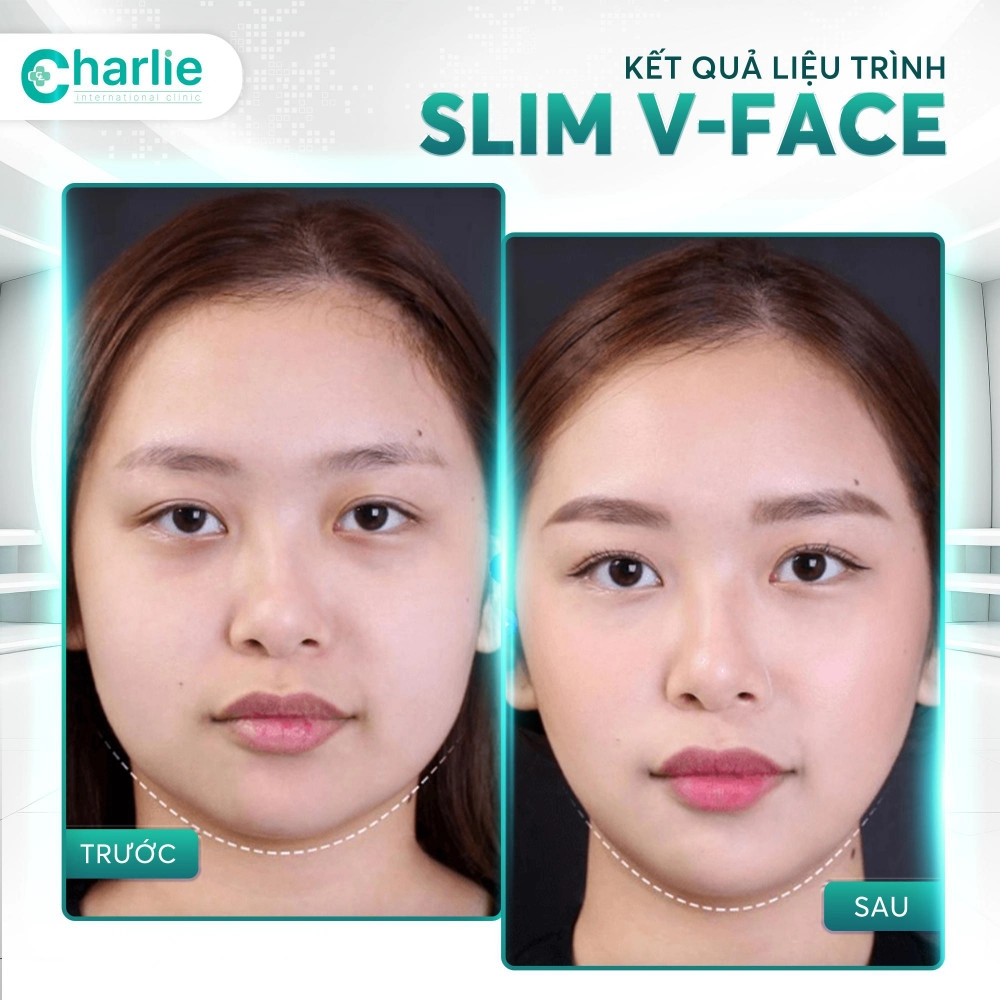 Công nghệ thon gọn hàm không phẫu thuật slim v-face - bước tiến ưu việt trong công nghệ làm đẹp 2024