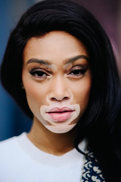  người mẫu bạch biến winnie harlow diễn cho victorias secret 