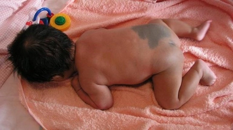 Sự thật về những vết bớt màu xanh trên cơ thể trẻ sơ sinh khiến mẹ ngạc nhiên
